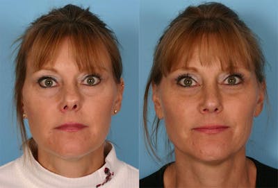 Rhinoplasty Before & After Gallery - Patient 348968 - Image 1