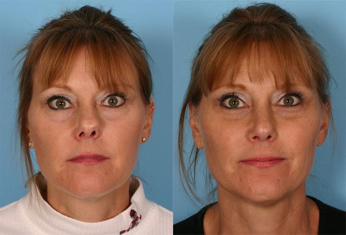 Rhinoplasty Before & After Gallery - Patient 348968 - Image 1