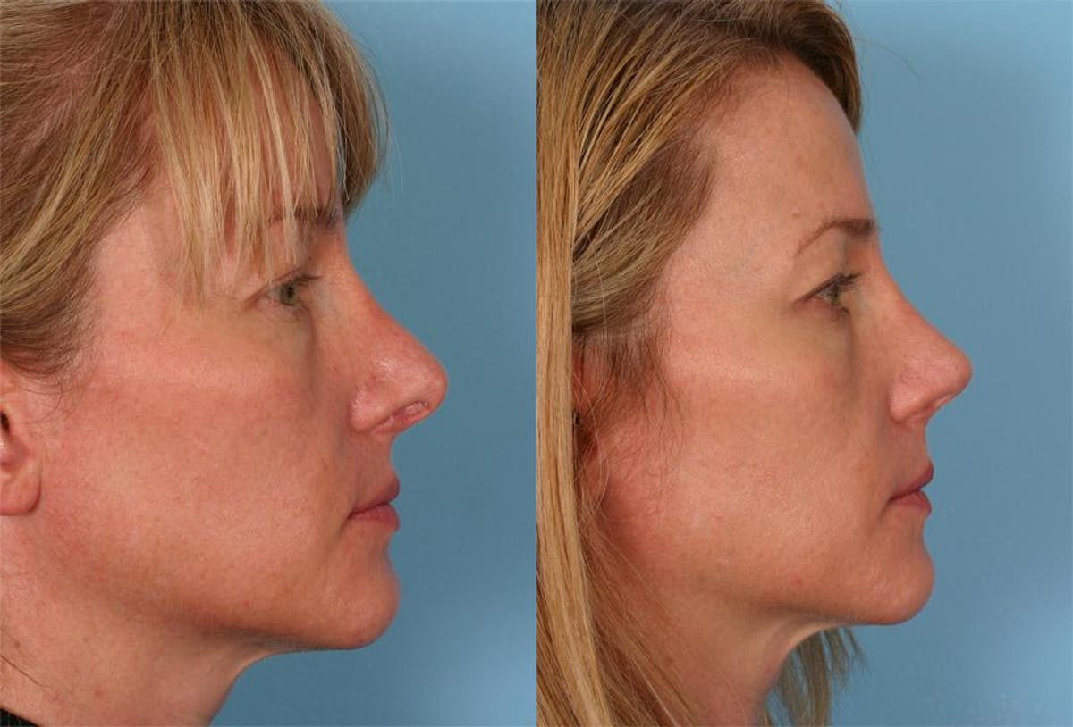 Revision Rhinoplasty Before & After Gallery - Patient 237272 - Image 2