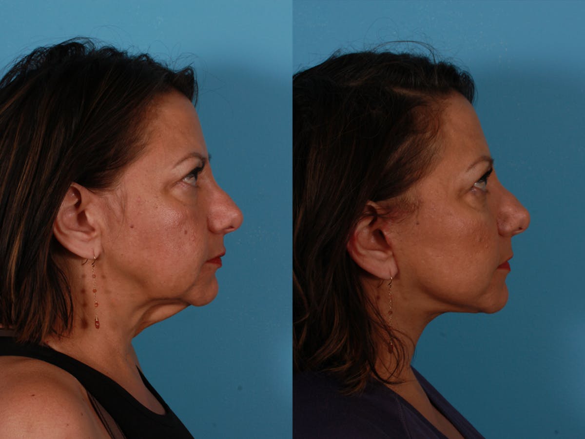 Facelift Before & After Gallery - Patient 300494 - Image 3
