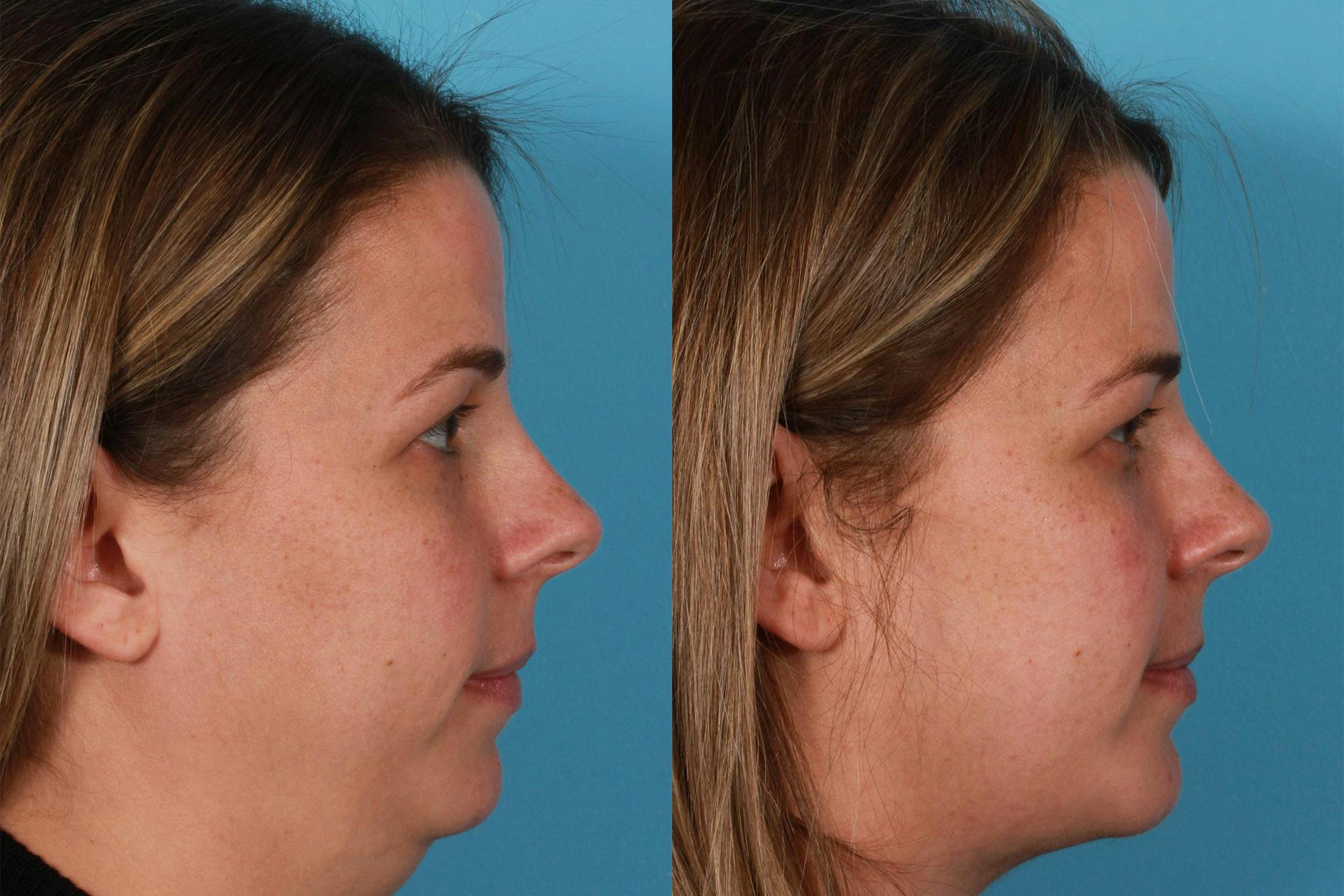 Neck Lift Before & After Gallery - Patient 310996 - Image 2