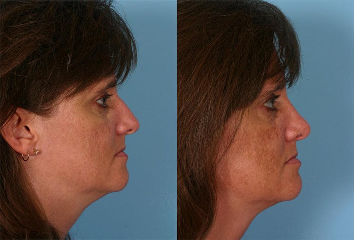 Nasal Obstruction Before & After Gallery - Patient 380930 - Image 2