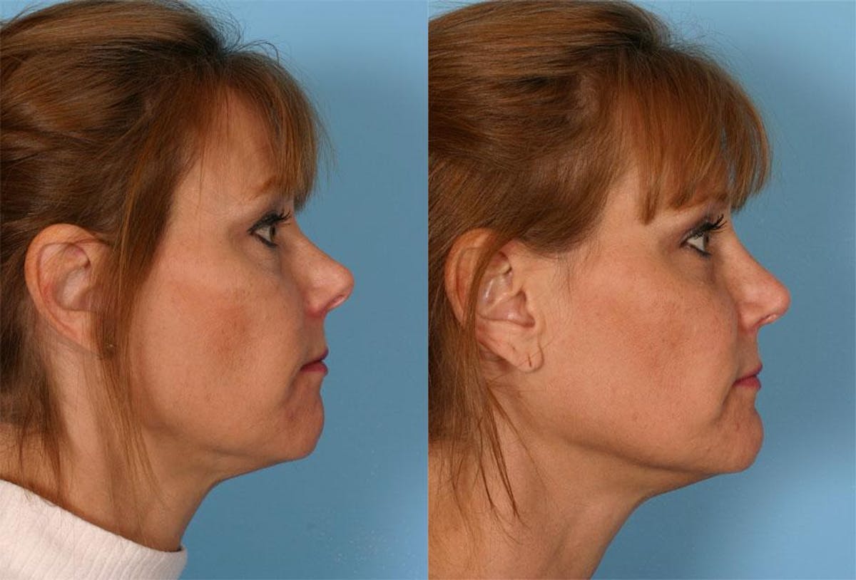 Rhinoplasty Before & After Gallery - Patient 348968 - Image 2