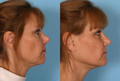 Rhinoplasty Before & After Gallery - Patient 348968 - Image 1
