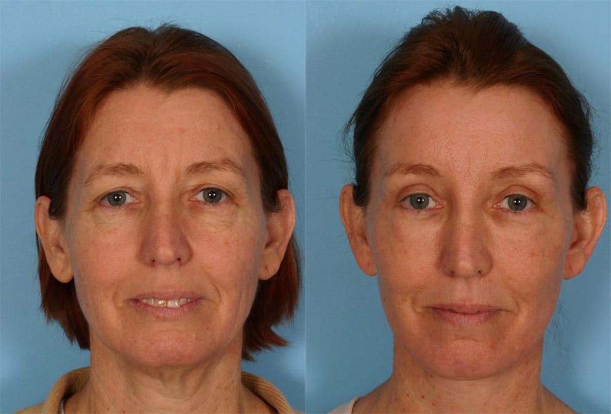 Endoscoplic Browlift Before & After Gallery - Patient 377121 - Image 1