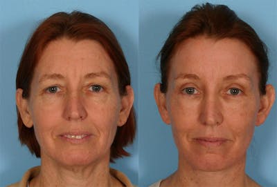 Endoscoplic Browlift Before & After Gallery - Patient 377121 - Image 1