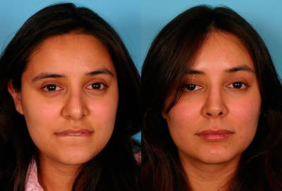 Revision Rhinoplasty Before & After Gallery - Patient 400609 - Image 1