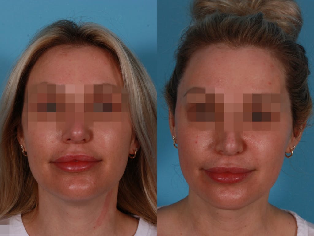Submental Microliposuction Before & After Gallery - Patient 310066 - Image 1