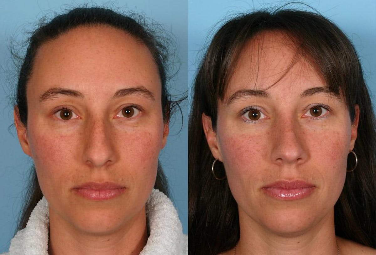 Rhinoplasty Before & After Gallery - Patient 133911 - Image 1