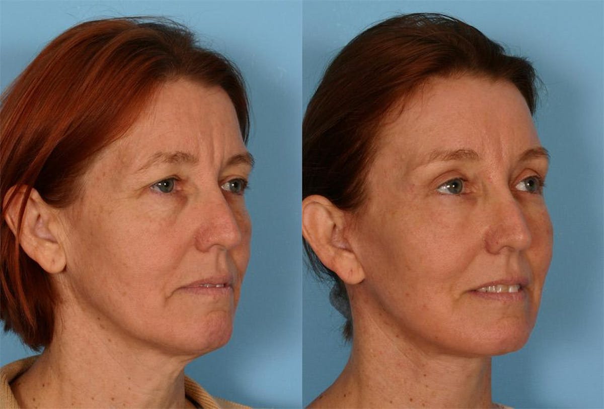 Endoscoplic Browlift Before & After Gallery - Patient 377121 - Image 2