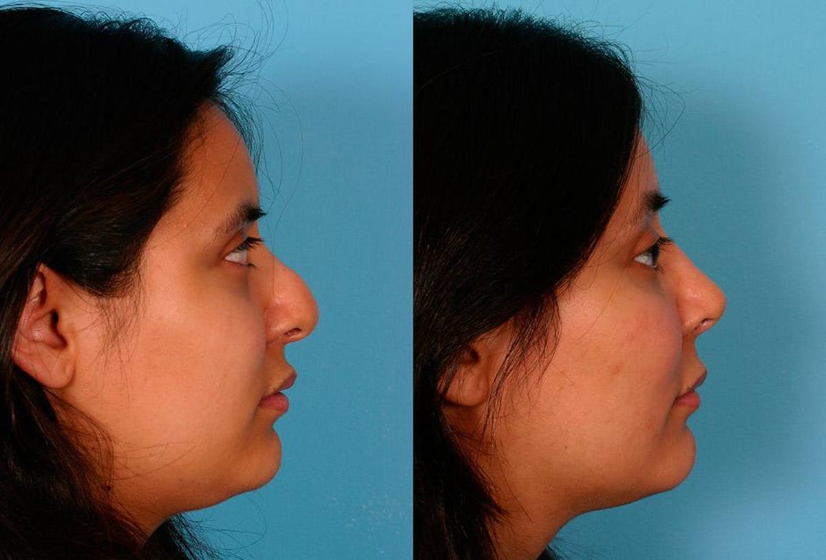 Revision Rhinoplasty Before & After Gallery - Patient 400609 - Image 2