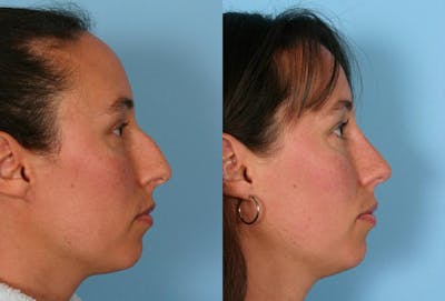 Rhinoplasty Before & After Gallery - Patient 133911 - Image 1