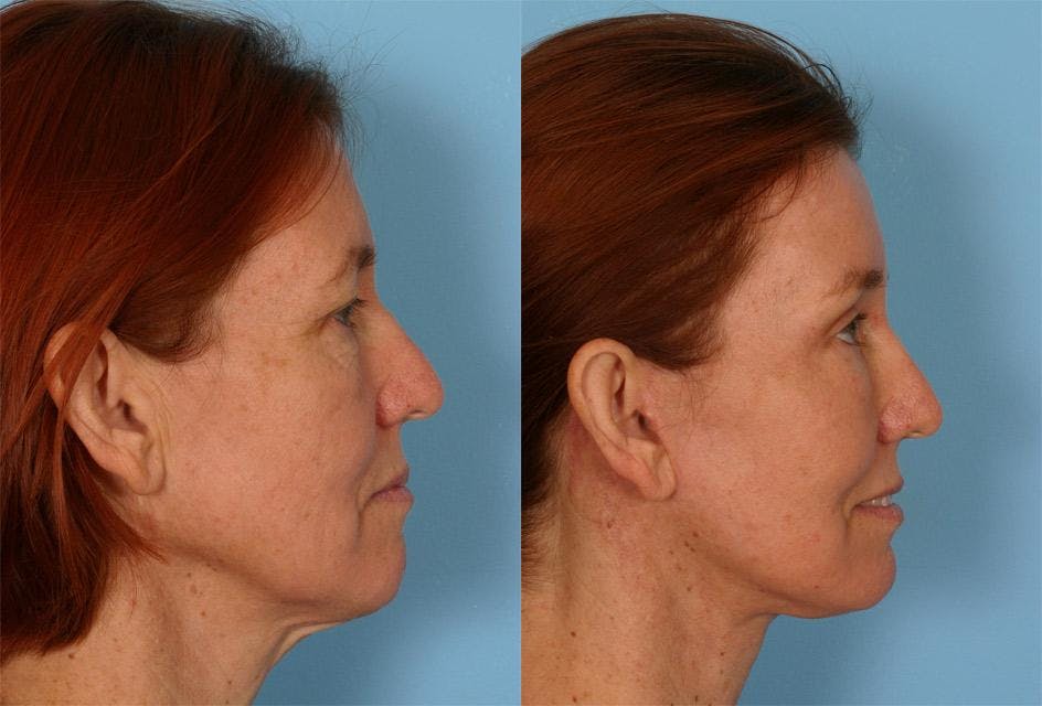 Endoscopic Brow Lift Before & After Gallery - Patient 377121 - Image 3
