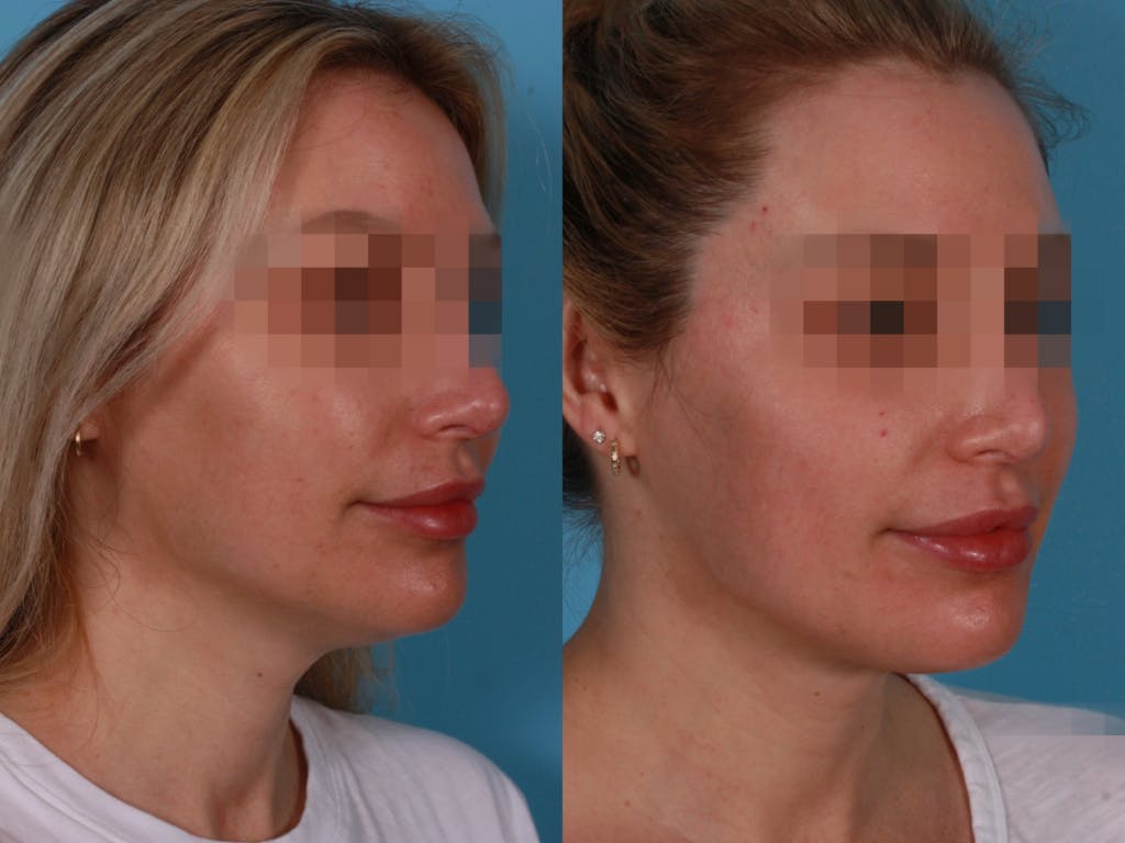 Submental Microliposuction Before & After Gallery - Patient 310066 - Image 2