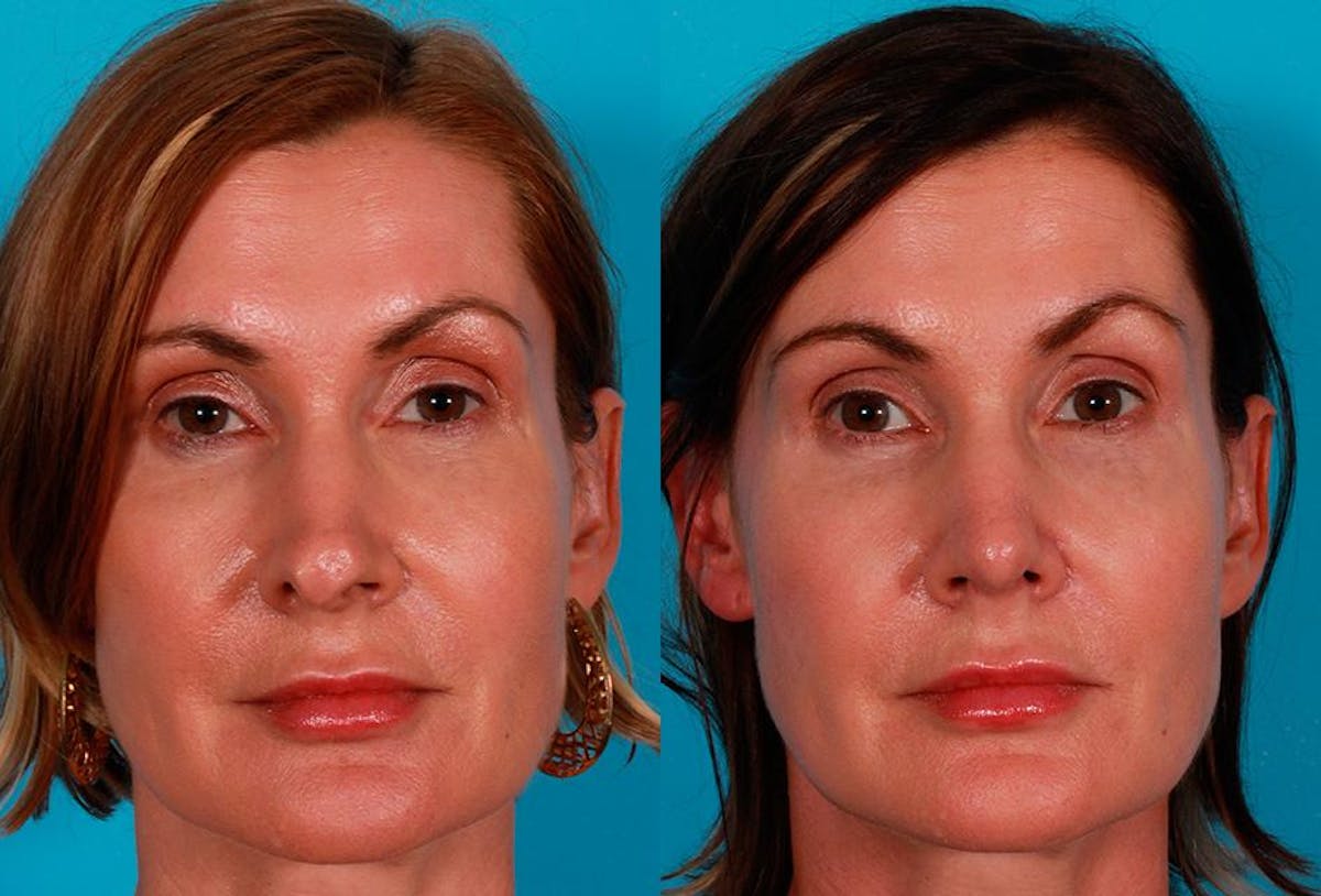 Revision Rhinoplasty Before & After Gallery - Patient 644281 - Image 1