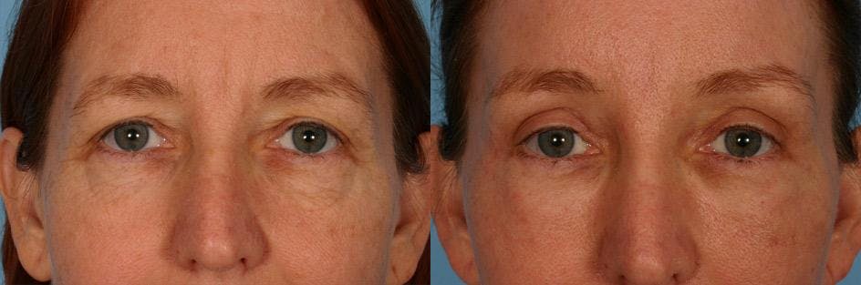 Endoscopic Brow Lift Before & After Gallery - Patient 377121 - Image 4