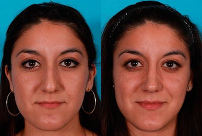 Rhinoplasty Before & After Gallery - Patient 309607 - Image 1
