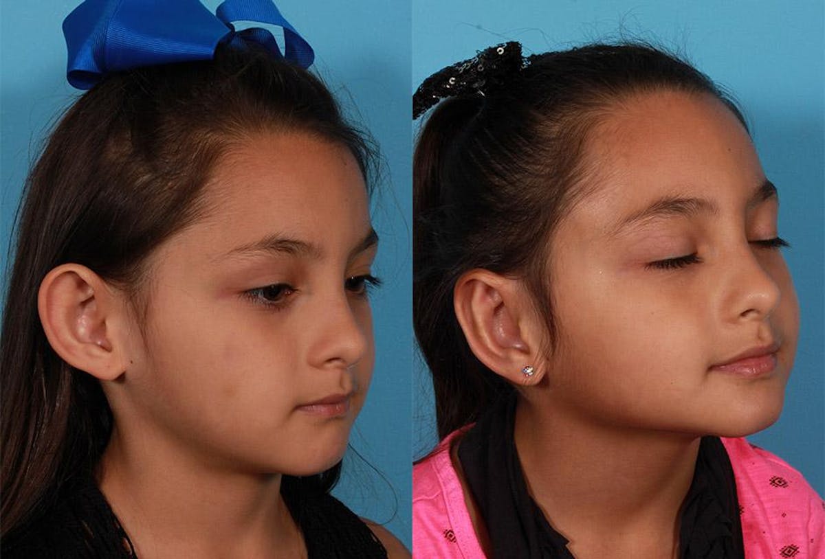 Ear Surgery (Otoplasty) Before & After Gallery - Patient 224665 - Image 2