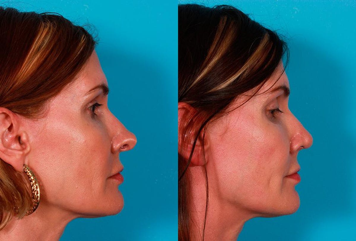 Revision Rhinoplasty Before & After Gallery - Patient 644281 - Image 2