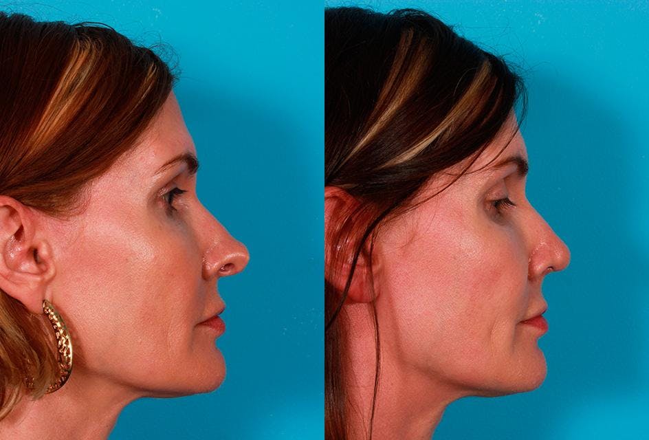 Revision Rhinoplasty Before & After Gallery - Patient 644281 - Image 2