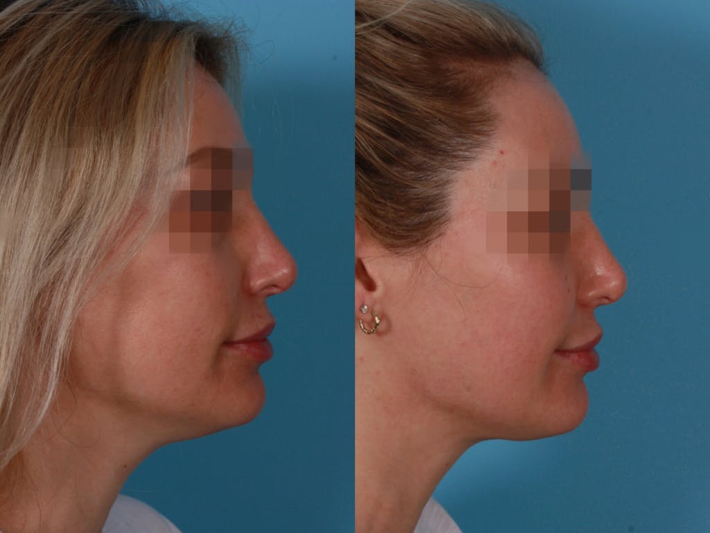 Submental Microliposuction Before & After Gallery - Patient 310066 - Image 3