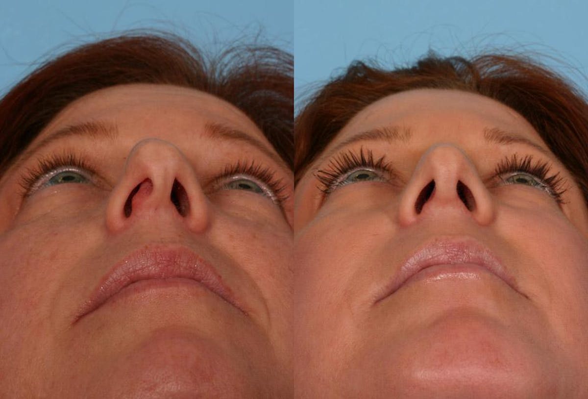Nasal Obstruction Before & After Gallery - Patient 415782 - Image 4