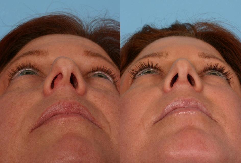 Nasal Obstruction Before & After Gallery - Patient 415782 - Image 4