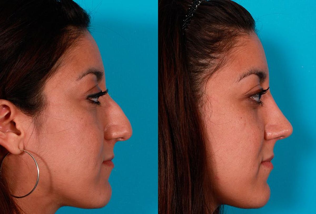 Rhinoplasty Before & After Gallery - Patient 309607 - Image 2