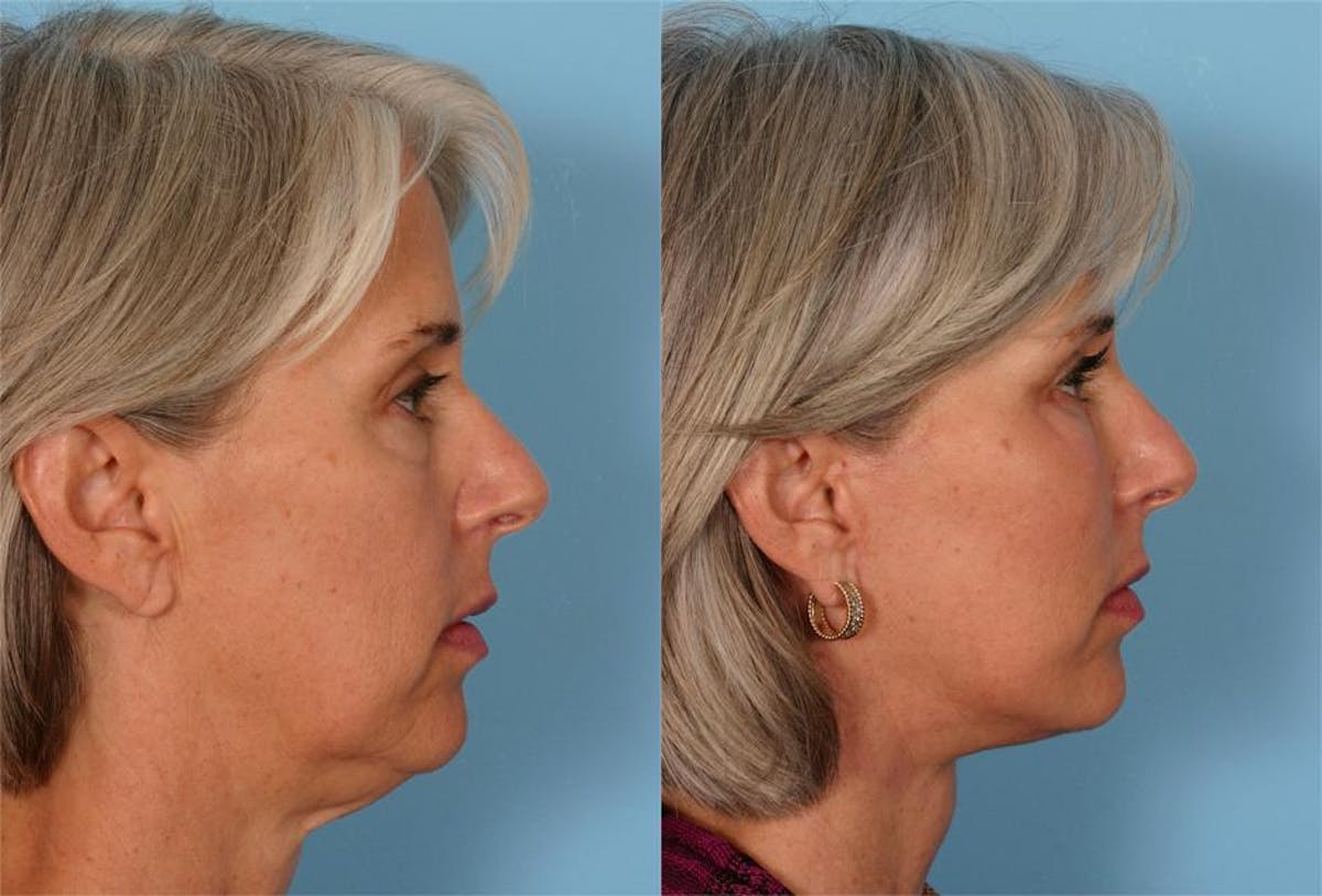Facelift Before & After Gallery - Patient 389662 - Image 3