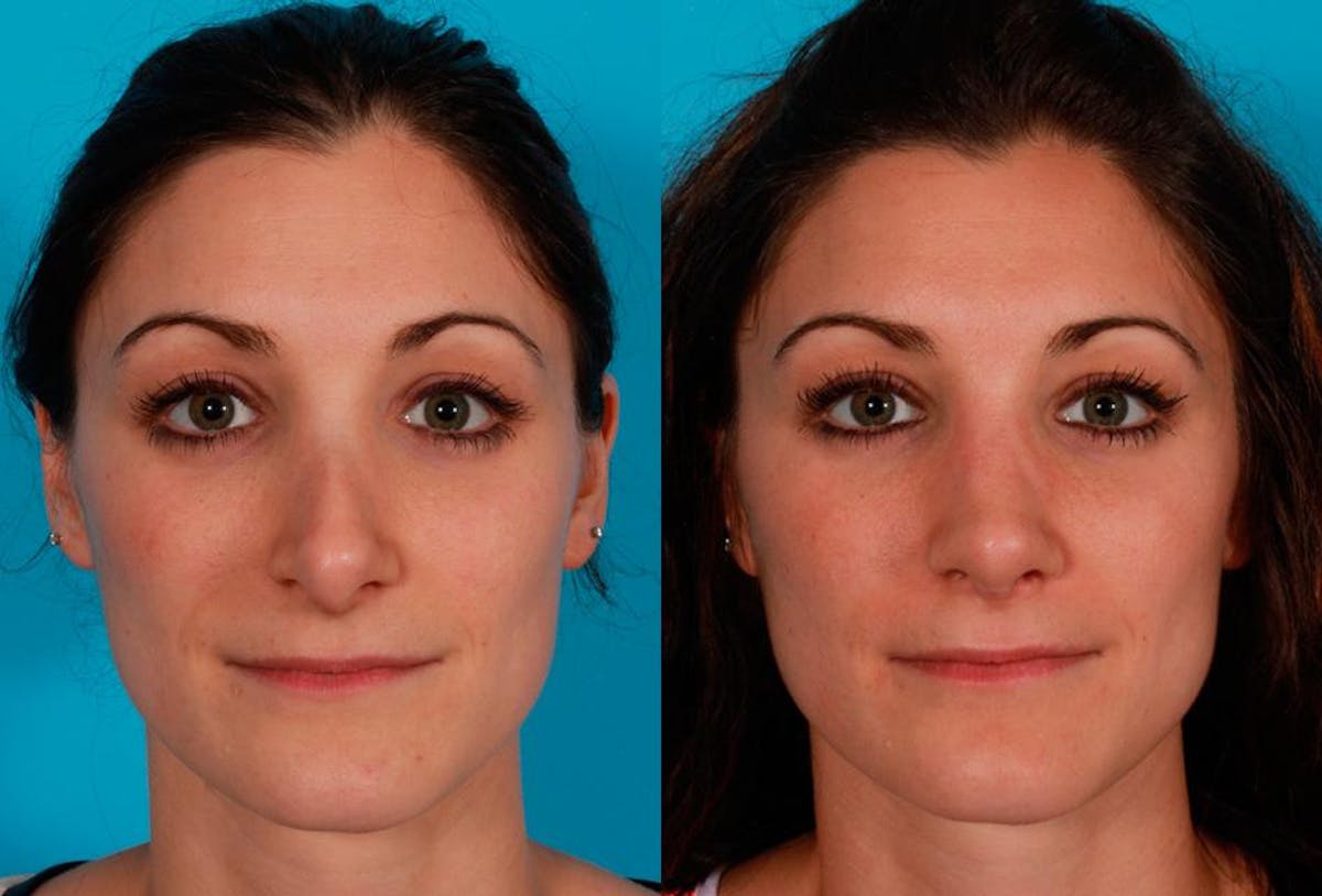 Revision Rhinoplasty Before & After Gallery - Patient 338022 - Image 1