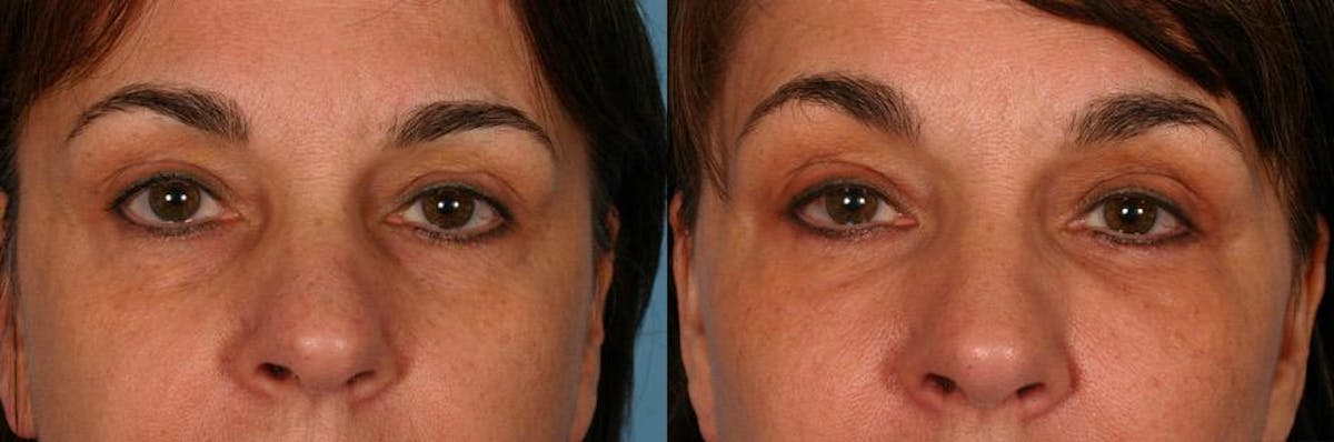 Eyelid Surgery (Blepharoplasty) Before & After Gallery - Patient 261977 - Image 4