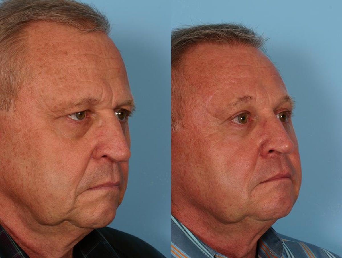 Endoscoplic Browlift Before & After Gallery - Patient 270433 - Image 2