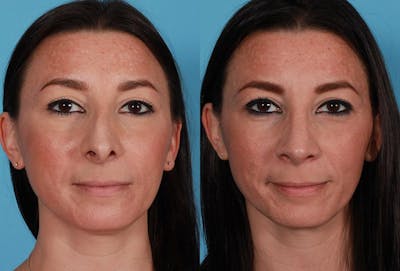 Rhinoplasty Before & After Gallery - Patient 209921 - Image 1