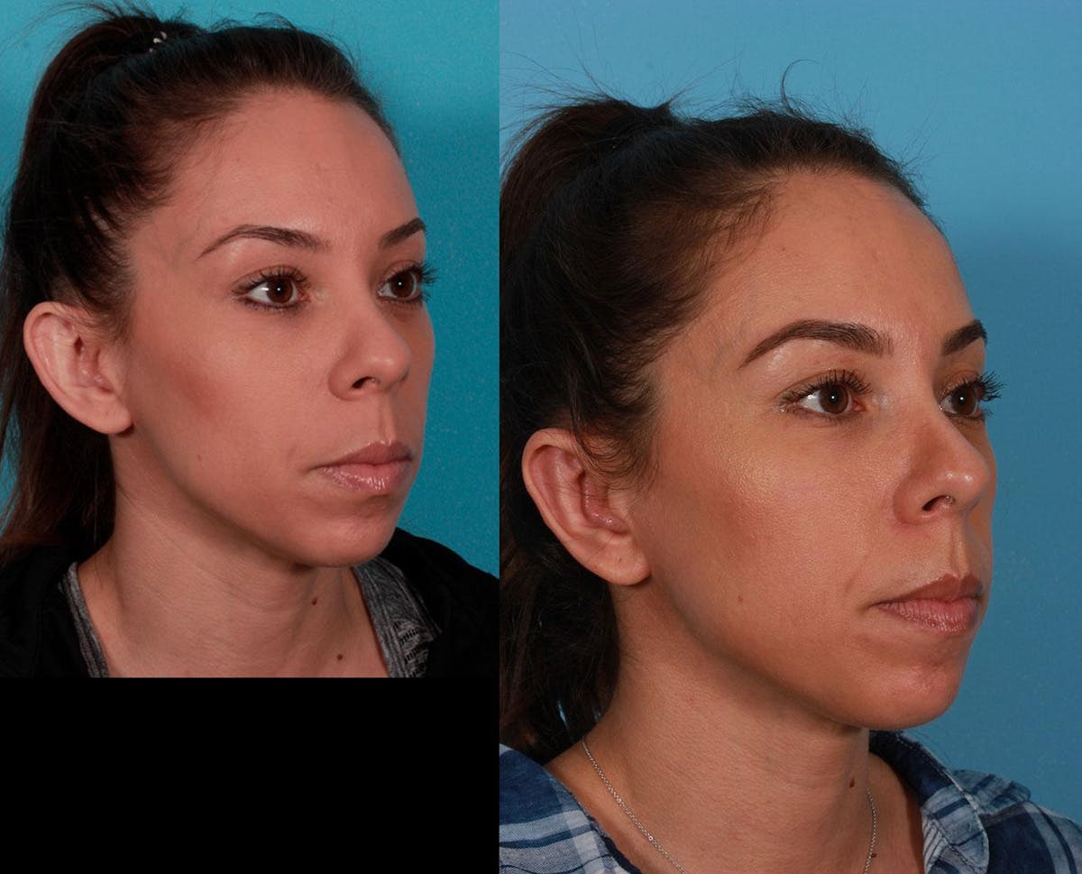 Ear Surgery (Otoplasty) Before & After Gallery - Patient 125281 - Image 2