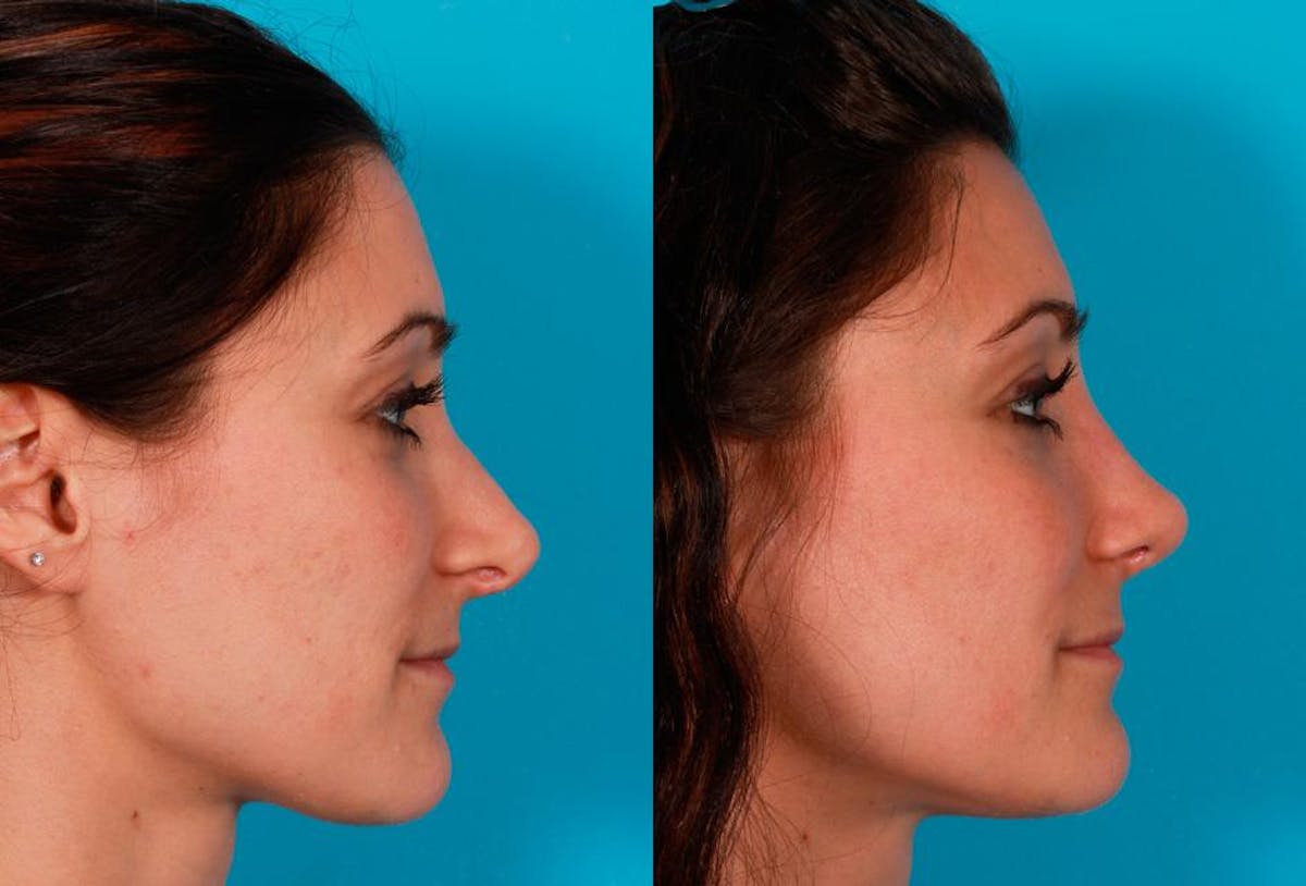 Revision Rhinoplasty Before & After Gallery - Patient 338022 - Image 2