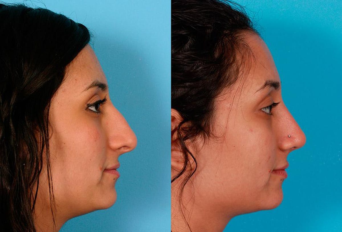 Nasal Obstruction Before & After Gallery - Patient 292079 - Image 2