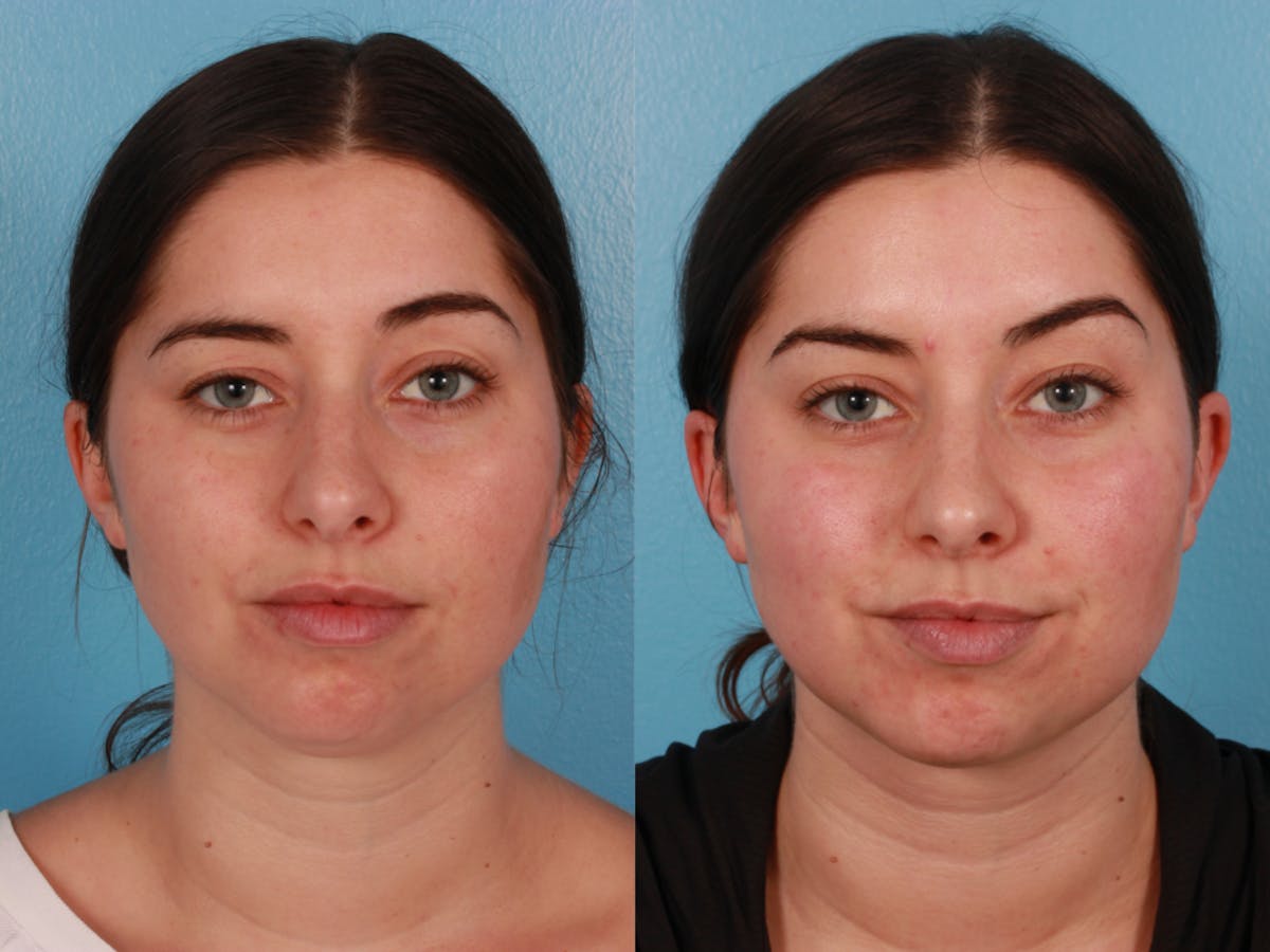 Submental Microliposuction  Before & After Gallery - Patient 375684 - Image 1