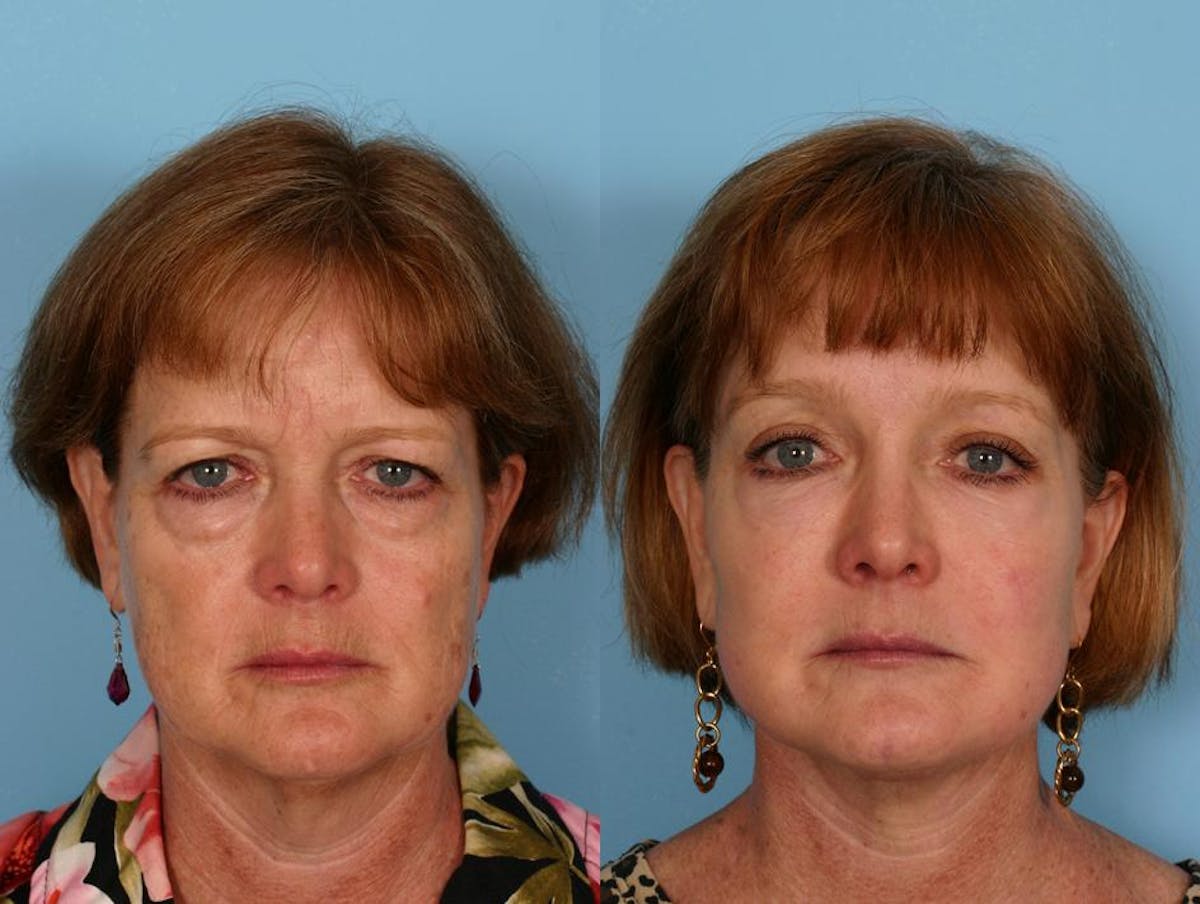 Facelift Before & After Gallery - Patient 295933 - Image 1