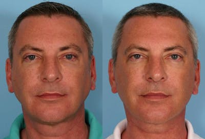 Limited Incision Facelift Before & After Gallery - Patient 302619 - Image 1