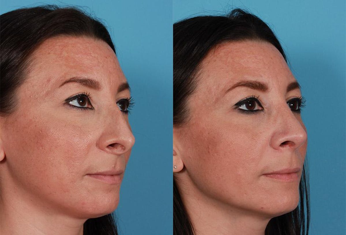Rhinoplasty Before & After Gallery - Patient 209921 - Image 3