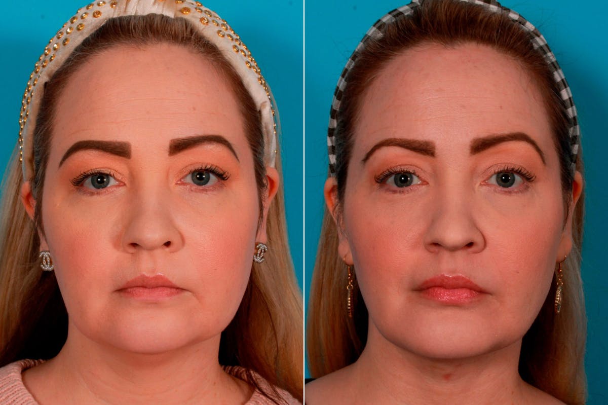Necklift Before & After Gallery - Patient 387292 - Image 1