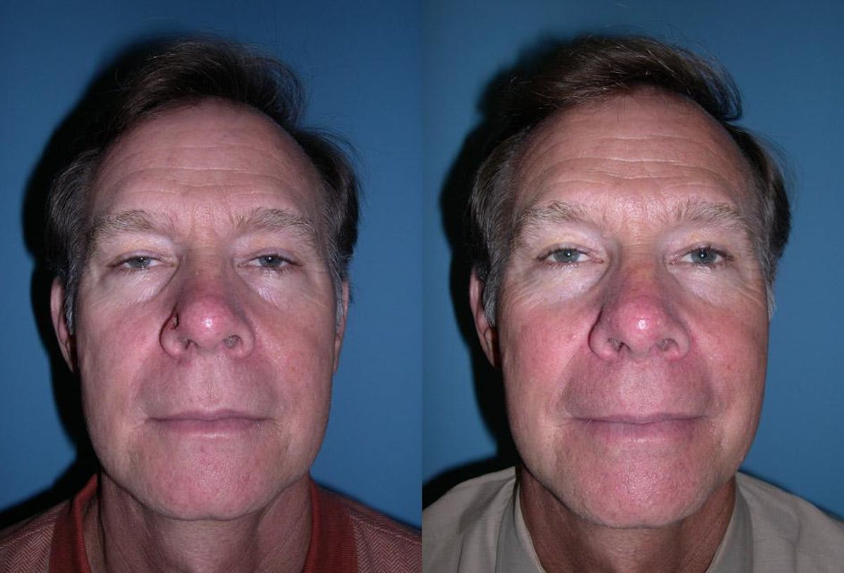 Skin Cancer Before & After Gallery - Patient 716863 - Image 1