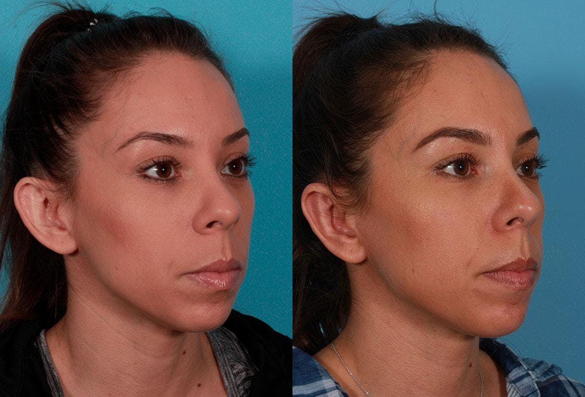 Ear Surgery (Otoplasty) Before & After Gallery - Patient 125281 - Image 2