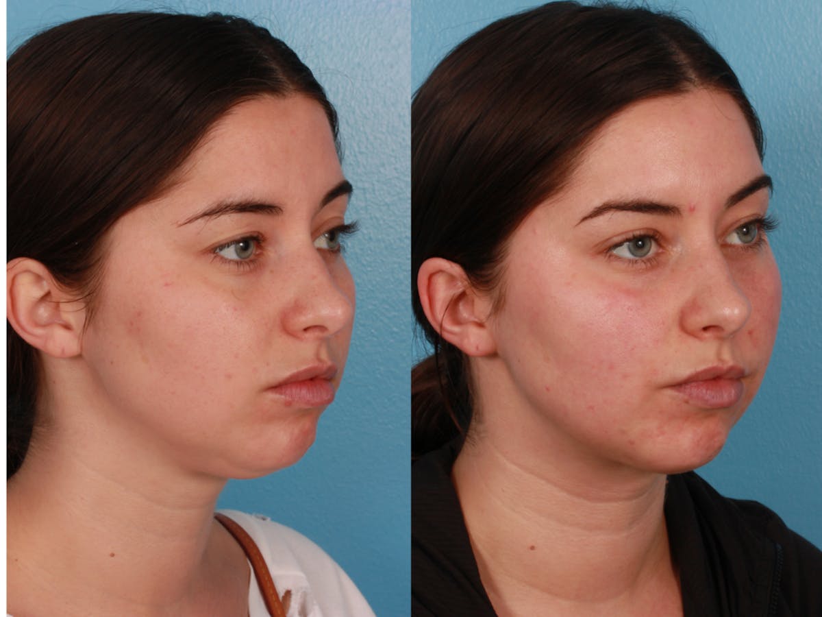 Submental Microliposuction  Before & After Gallery - Patient 375684 - Image 2