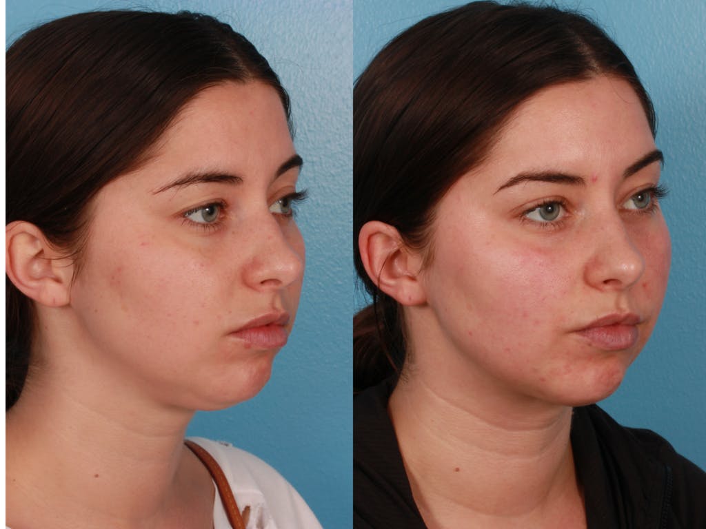 Submental Microliposuction Before & After Gallery - Patient 375684 - Image 2
