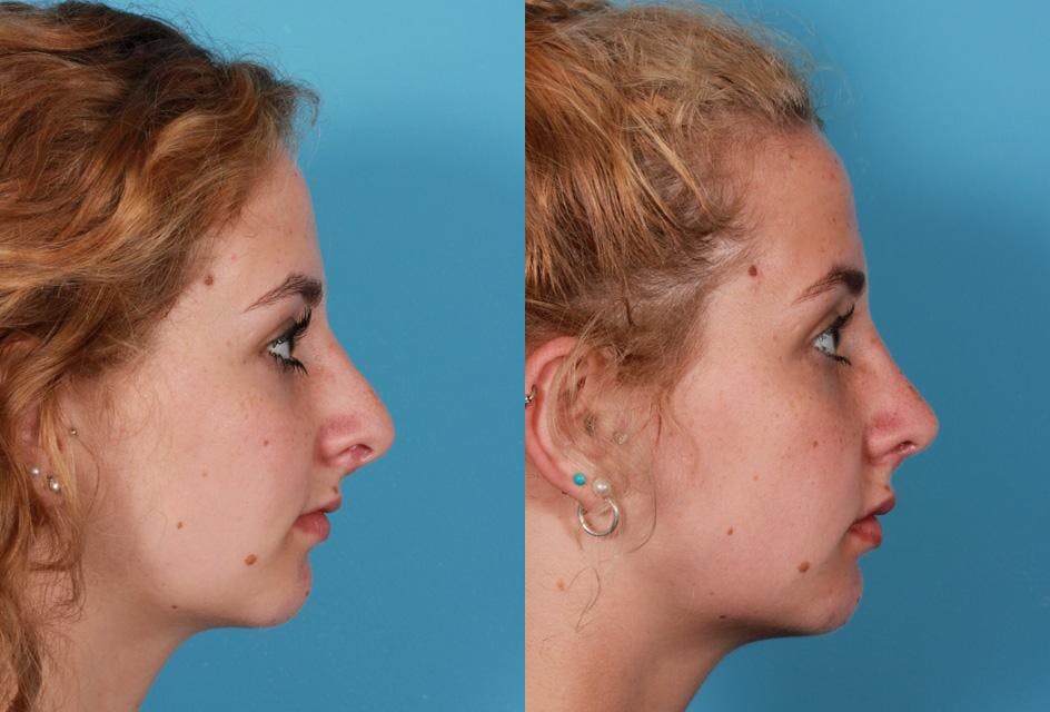 Revision Rhinoplasty Before & After Gallery - Patient 197318 - Image 2