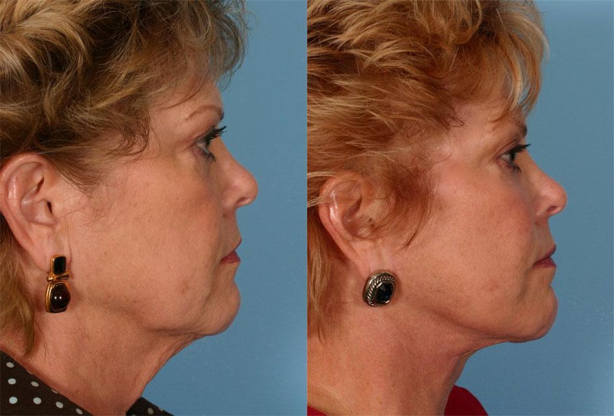 Eyelid Surgery (Blepharoplasty) Before & After Gallery - Patient 433134 - Image 3
