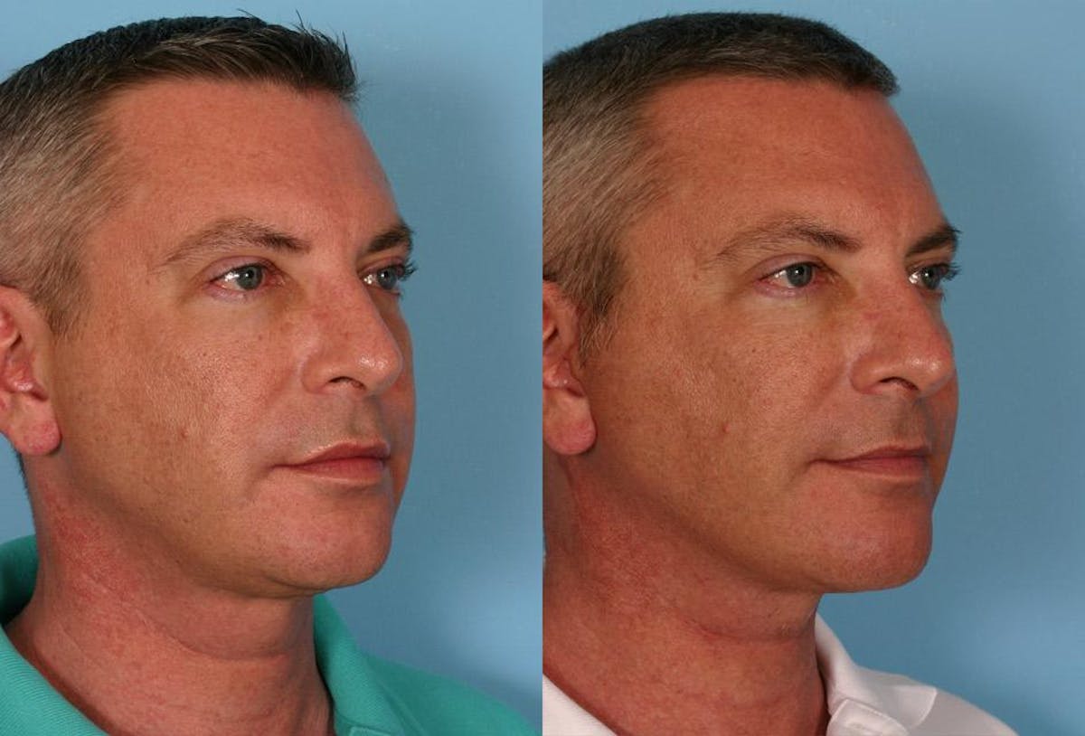 Limited Incision Facelift Before & After Gallery - Patient 302619 - Image 2