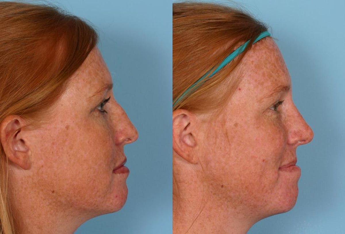 Nasal Obstruction Before & After Gallery - Patient 918195 - Image 2