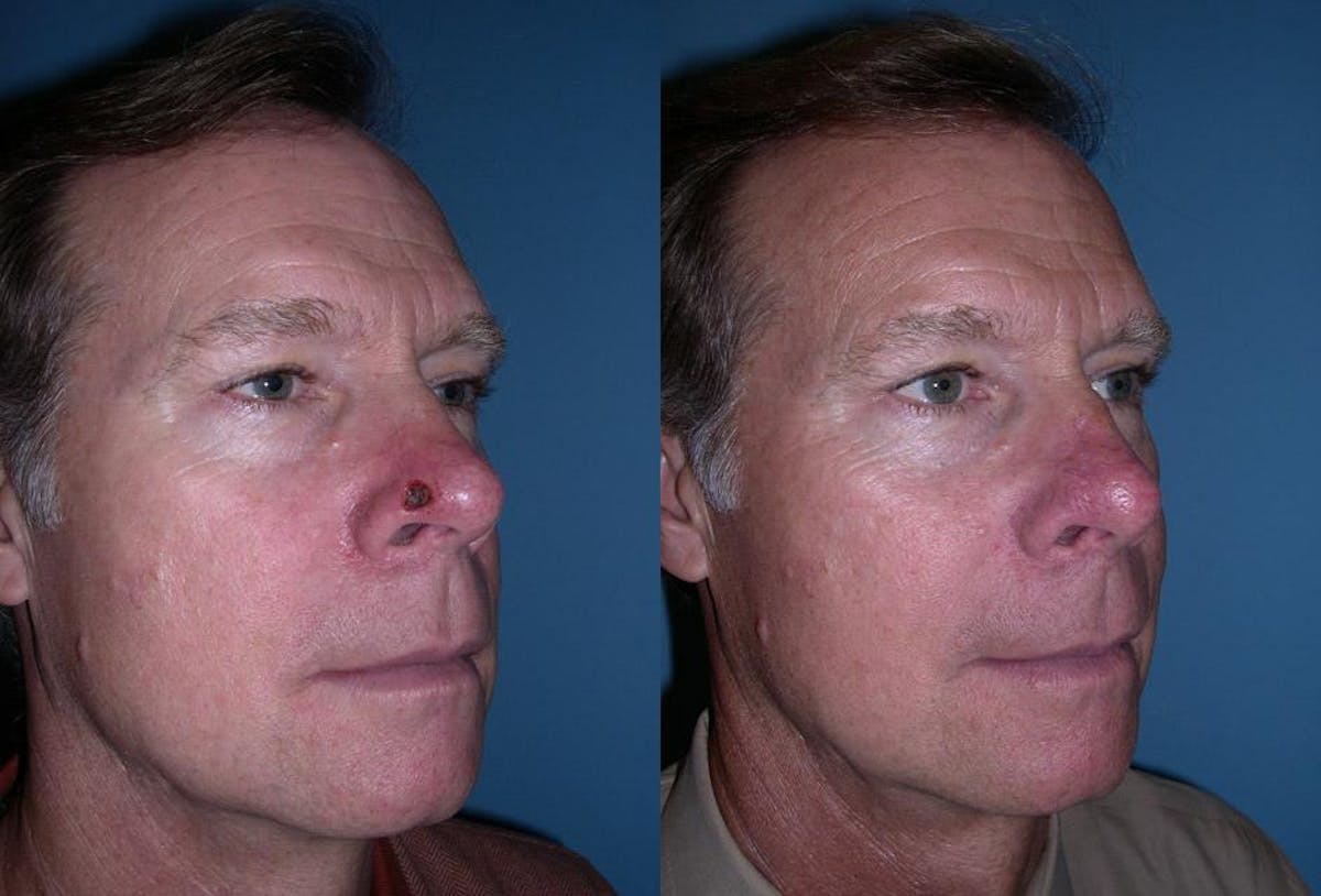 Skin Cancer Before & After Gallery - Patient 716863 - Image 2